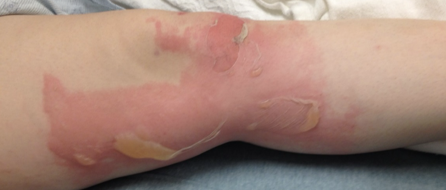 Mechanism and Management of Scald Burns